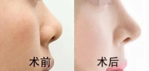 隆鼻术价格