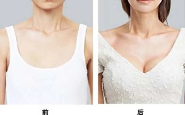 妙桃假体隆胸什么价格
