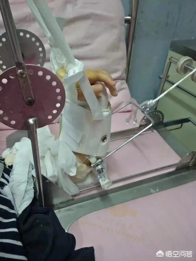 重庆一女童在幼儿园摔骨折,家长怀疑是老师报复,你怎么看?